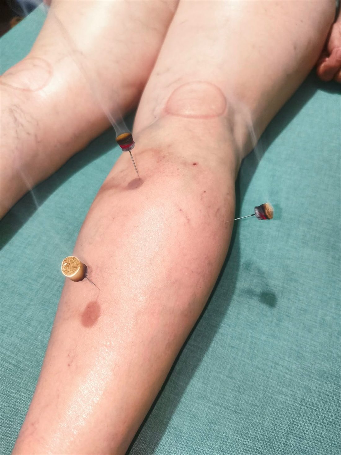 Agujas de acupuntura con moxa sobre la rodilla